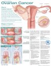 Understanding Ovarian Cancer Anatomical Chart