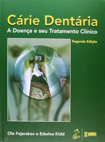 Cárie Dentária A Doença E Seu Tratamento Clínico