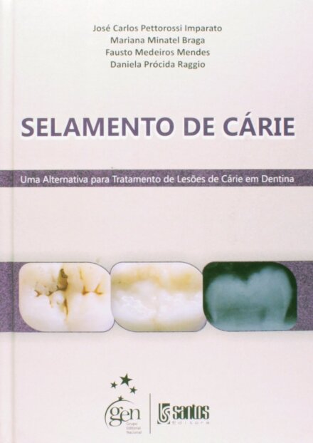 Selamento De Cárie Alternativa Para Tratamento Lesões