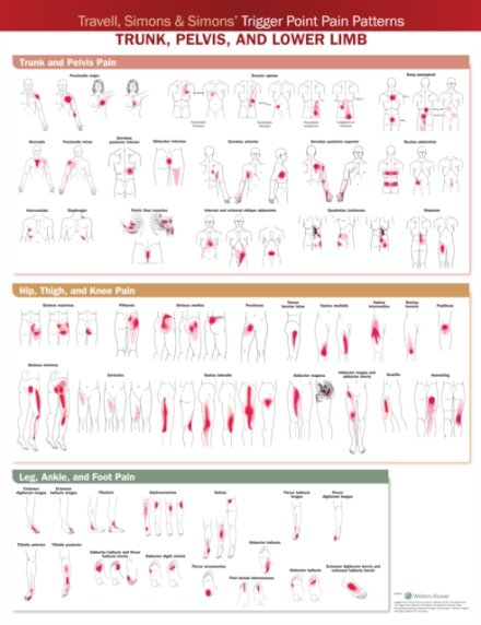 Travell, Simons & Simons’ Trigger Point Pain Patterns Wall Chart