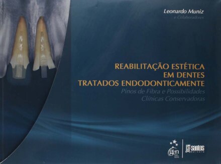 Reabilitação Estética Dentes Tratados Endodonticamente - Pinos de Fibra Possibilidades Clínicas Conservadoras